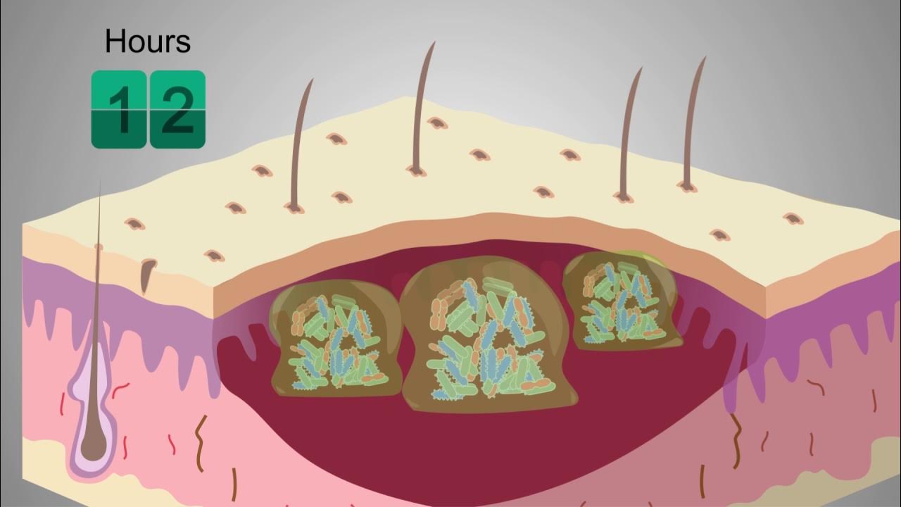 What are biofilms and how can wound healing be supported? Prontosan is the answer YouTube
