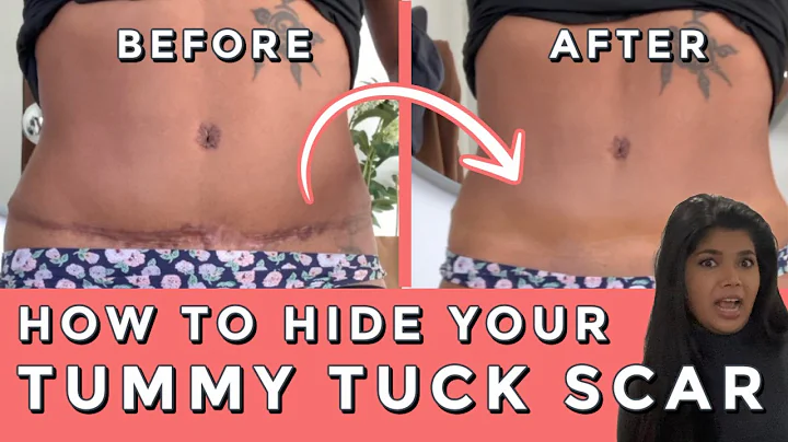 Concealing Tummy Tuck Scars: The Ultimate Guide