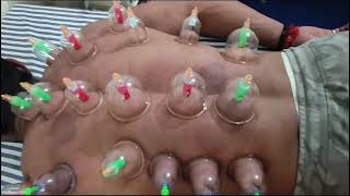 cupping therapy for sore back#healing hands physiotherapy clinic