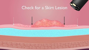 Colonoscopy: Endoscopic mucosal resection of 20 mm colon polyps