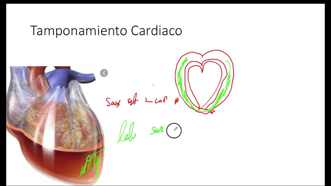 Electrical Alternans Alternancia electrica YouTube