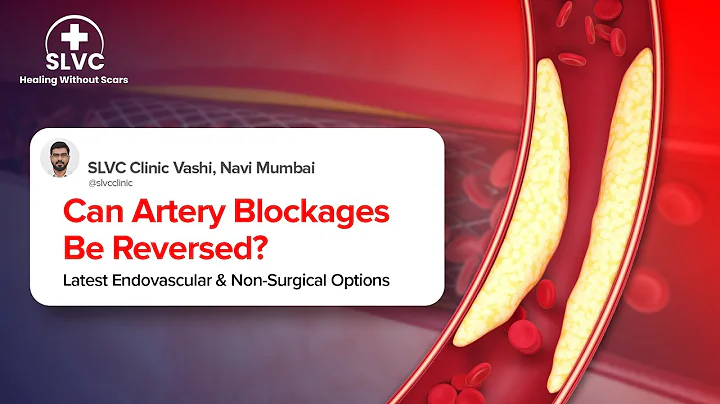 Can Artery Blockages Be Treated Without Surgery? | Dr. Sagar Satpute | SLVC Clinic Navi Mumbai