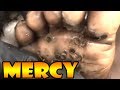 Mercy's BIGGEST Jiggers EXTENDED   With Blackhead Removal Tools