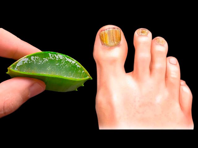 🔥Kills nail fungus instantly! The best remedy! Benefits of Aloe Vera class=