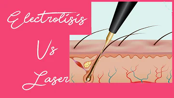 ¿Es mejor la electrólisis que la depilación láser?