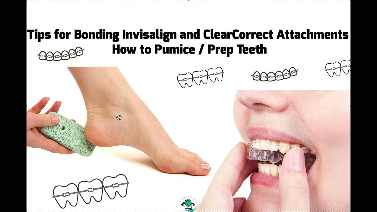 Tips and Tricks for Broken Invisalign Attachments YouTube