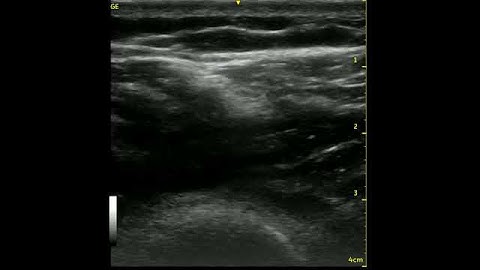 Ultrasonography of Local Twitch Response (LTR)