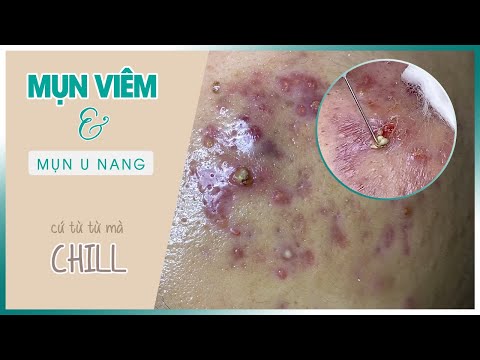 Video Khắc Phục Hậu Quả Do Trị Mụn Sai Cách | Hana Spa and... - youtube