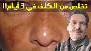 البشرة الجافة و الكلف!! الحل النهائي في ثلات أيام من الإستعمال!! الدكتور جمال الصقلي