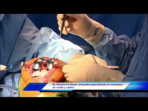 Vídeo: ¿Medicare Cubre La Cirugía De Reemplazo De Cadera?