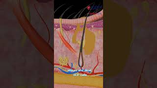 What's Inside A Pimple? How Does Acne Develop? Medical Arts Animation