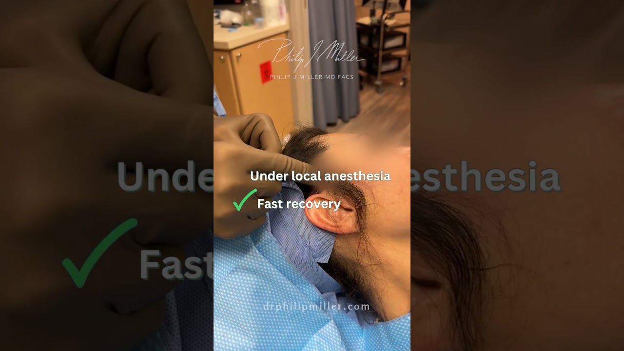 Custom Microlift-face under local anesthesia! Fast Recovery SMAS lift!