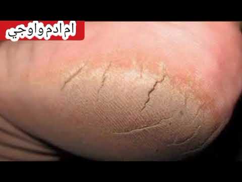 فيديو تجربة قطعتين من بخاخ عشبي لعلاج تشققات القدم