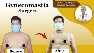 Gynecomastia Surgery in Kolkata | Man Boobs Reduction Surgery | Easy & Painless Process | Cosmo Aid