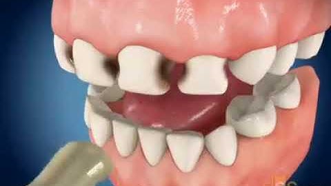 VÌ SAO RĂNG BÉ BỊ SÂU KHI BÚ BÌNH