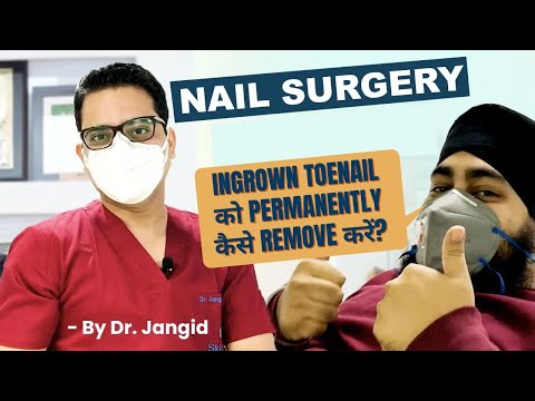 अंतर्वर्धित नाखूनों की नेल सर्जरी | डॉ जांगिड़ | अंतर्वर्धित toenail हटाने | अंतर्वर्धित toenail उपचार