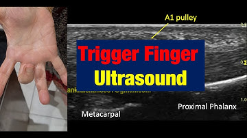 #Trigger Finger #Dynamic Ultrasound #Demonstration
