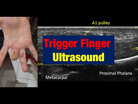 #Trigger Finger #Dynamic Ultrasound #Demonstration