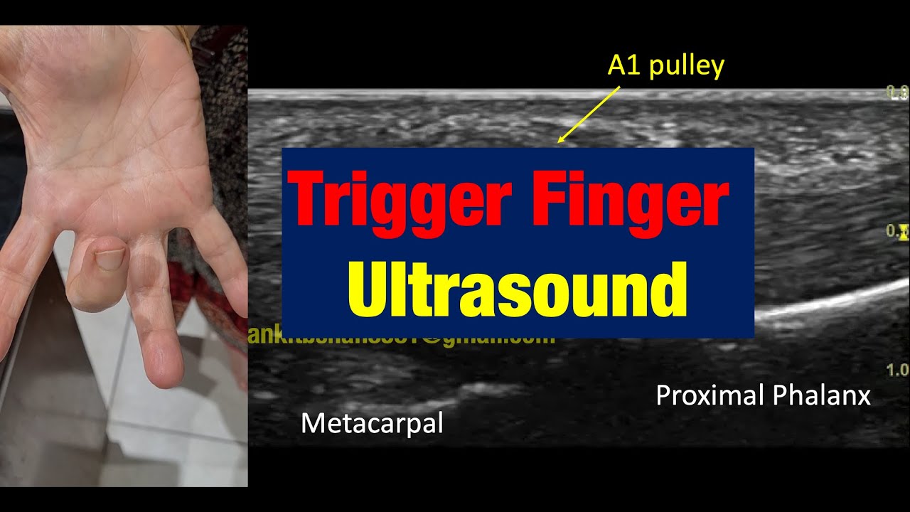 Trigger Finger Dynamic Ultrasound Demonstration YouTube