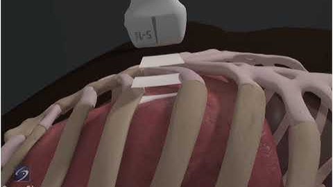 4. How To Lung Sliding Detection with Phased Array Transducer 3D Video _   Sonosite.