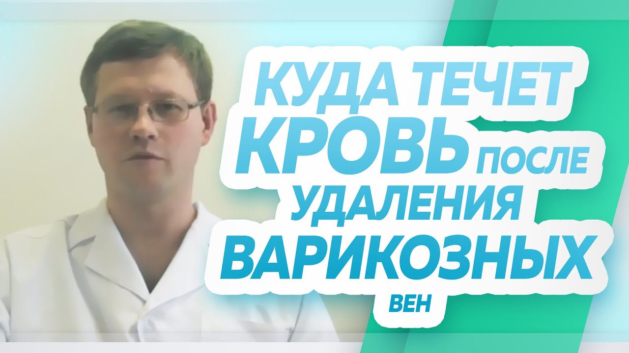 Куда же течёт кровь после удаления варикозных вен?