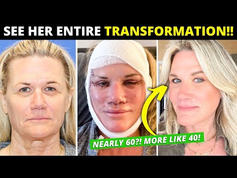 Facelift at Nearly 60 Changes Her Entire Life! Dramatic Vertical Restore Surgery Before/After!