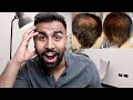 5 MONTH TURKEY HAIR TRANSPLANT UPDATE | YOU WON'T BELIEVE THIS!