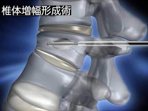 脊椎圧迫骨折の手術　椎体増幅形成術VP（Vessel‐Plasty）