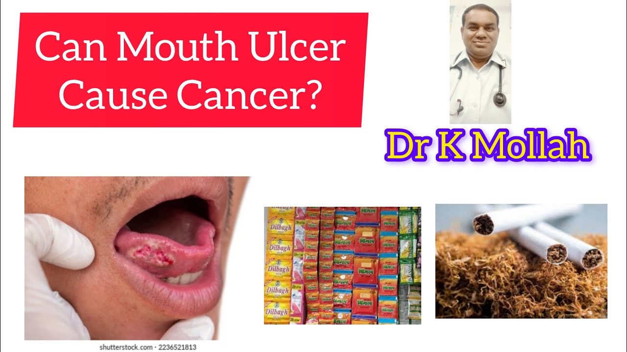 Mukhe Gha Mouth Ulcer Theke Ki Cancer Hote Pare Bengali Health mukhe-gha-mouth-ulcer-theke-ki-cancer-hote-pare-bengali-health