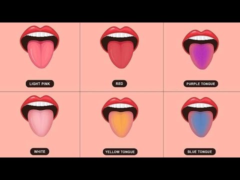 Video: Warna Lidah: Apa Yang Sihat, Apa Yang Tidak, Diagnosis Lidah