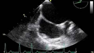 Tee Ra Pectinate Muscle