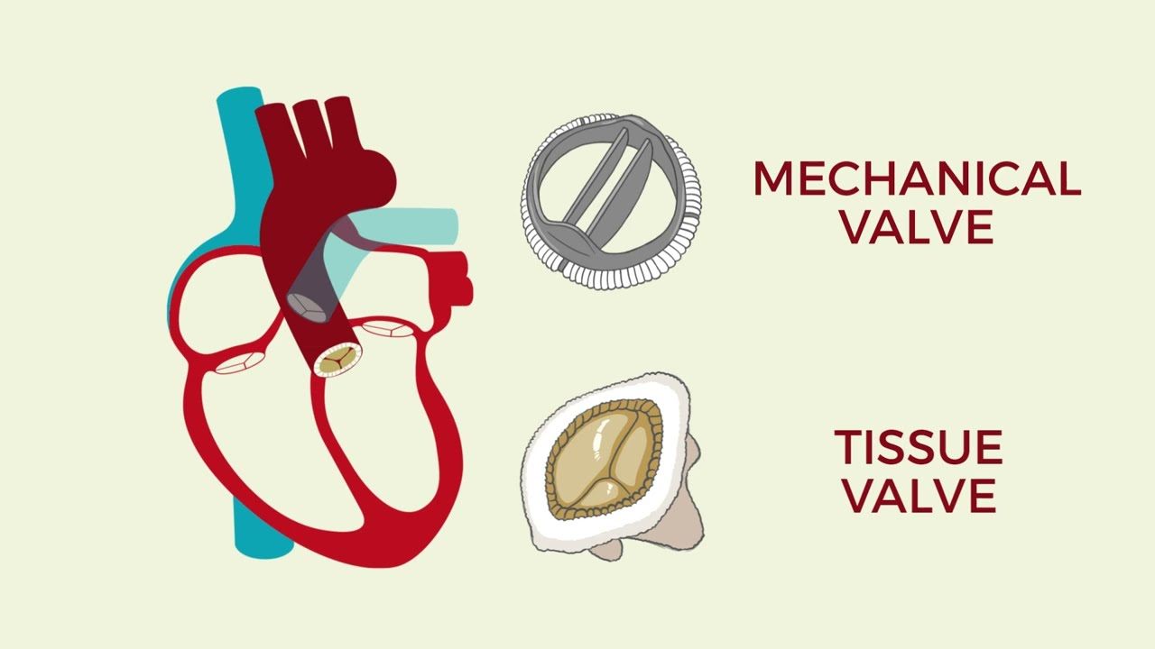 A Guide to Understanding the Ross Procedure (Part 2) - Aortic Valve Replacement