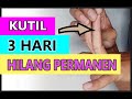 Cara Menghilangkan Kutil Secara Permanen