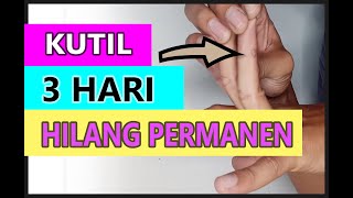 Cara Menghilangkan Kutil Secara Permanen