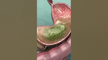 Acidity Ke Lakshan Acidity Kaise Hoti Hai Kya Khane Se Acidity Hoti Hai 