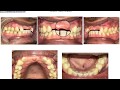 Caso Clinico com Provisório de 3 Dentes