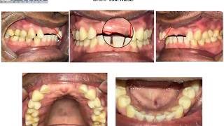 Caso Clinico com Provisório de 3 Dentes