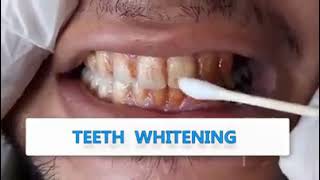 قطرات تبييض الاسنان
