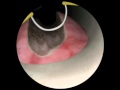 TURP Prostate Resection Median Lobe 