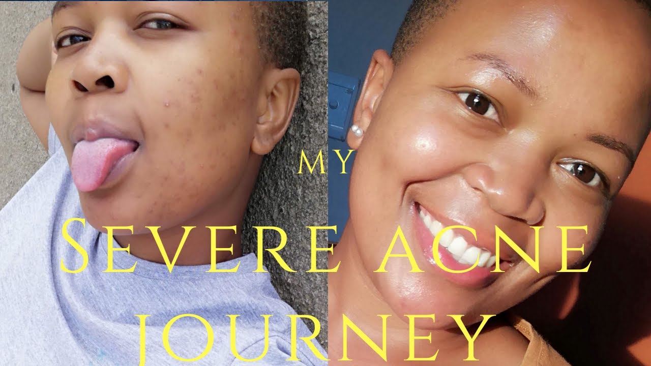 MY ACNE JOURNEY |SOUTH AFRICAN YOUTUBER - YouTube