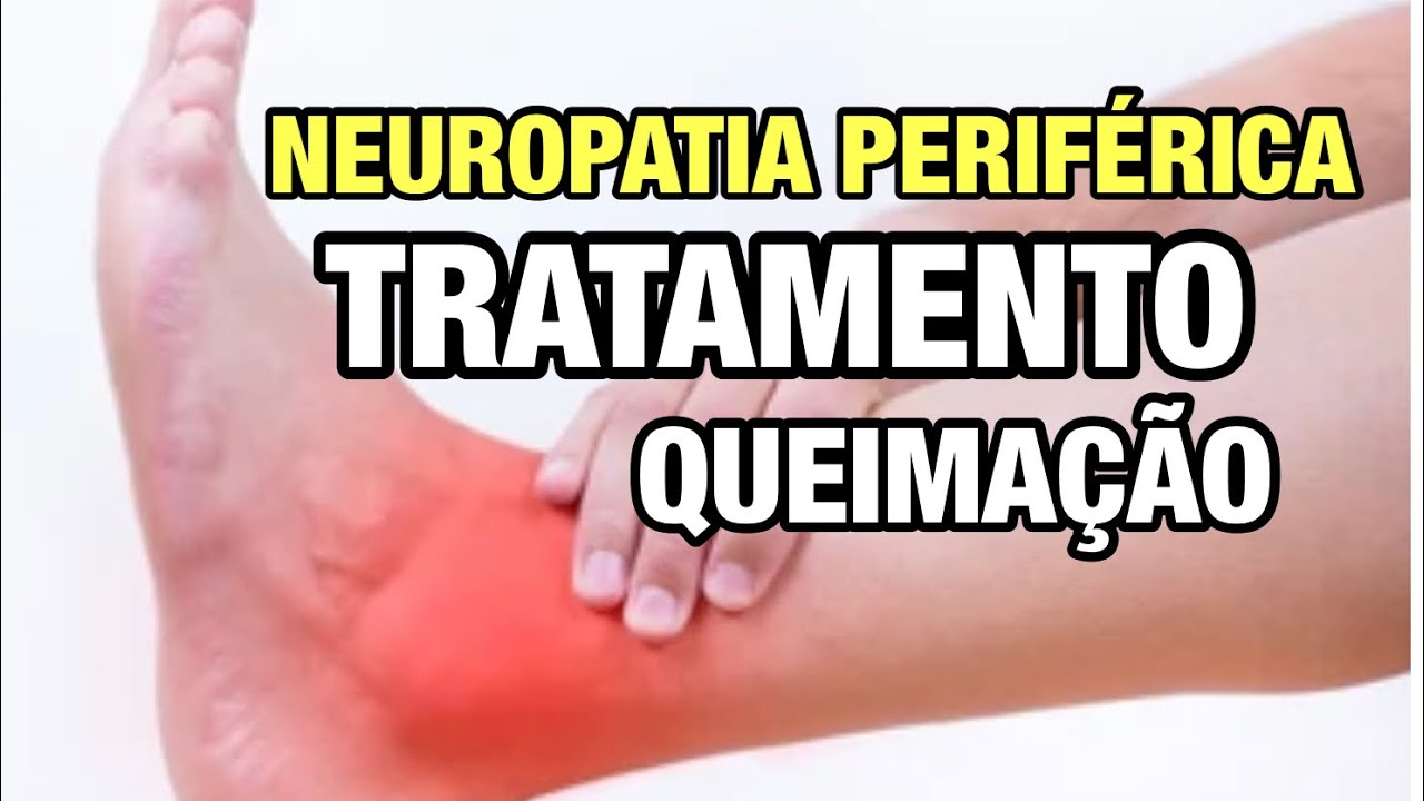 Neuropatia periférica e o formigamento nos pés TEM TRATAMENTO COMPLEXO ...