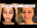 HOW I CLEARED MY SKIN IN 2 MONTHS!