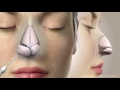 Rhinoplasty nose job animation  guncel ozturk md  drgo