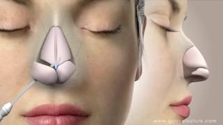 Rhinoplasty (Nose Job) Video Animation - Guncel Ozturk, MD - #DRGO screenshot 5