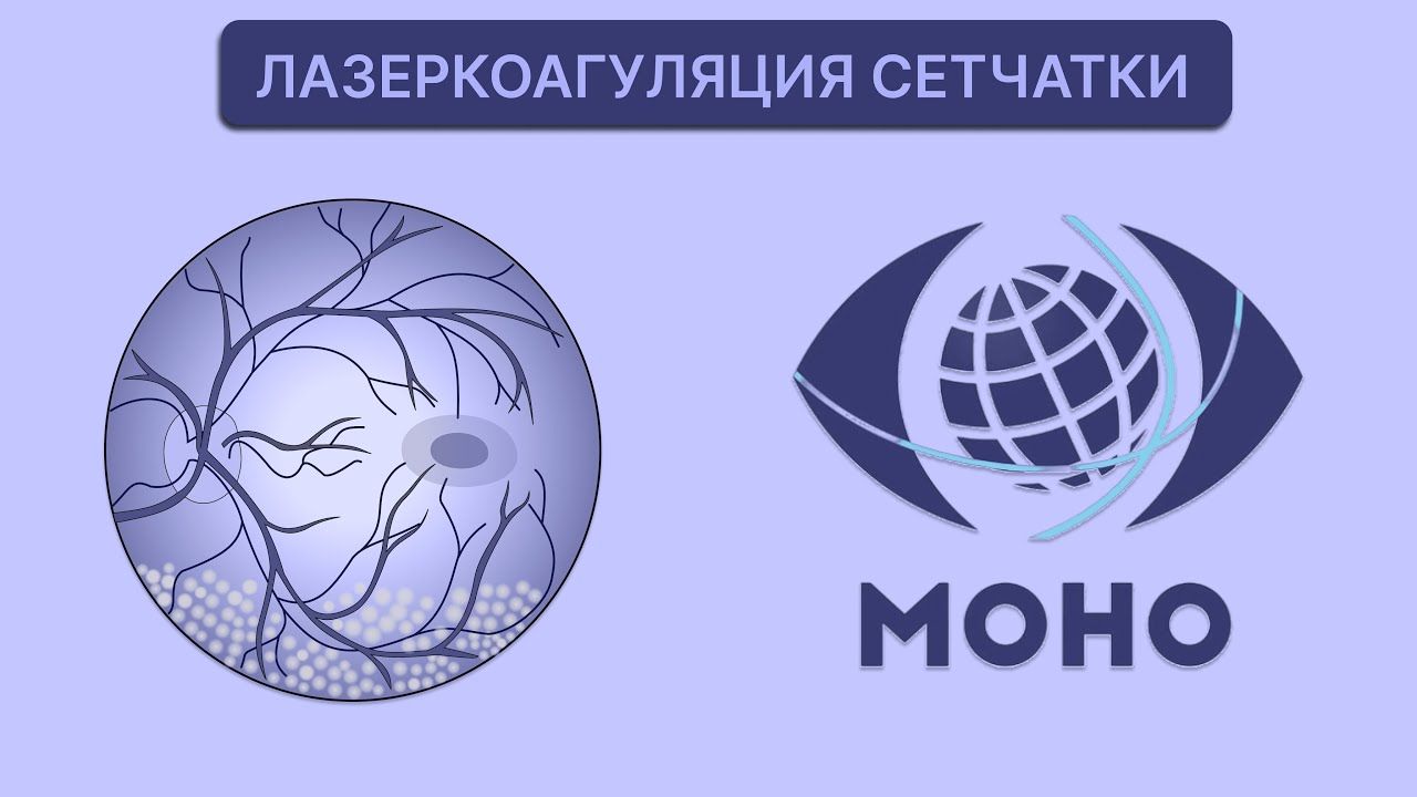 Лазеркоагуляция сетчатки. Как лазер влияет на глаза? 3-е заседание МОНО ...