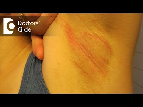 Video: Epidermophytosis - Orsaker Och Symtom På Epidermophytosis Inguinal. Förebyggande Och Behandling