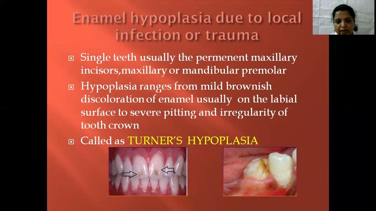 Enamel Hypoplasia. YouTube