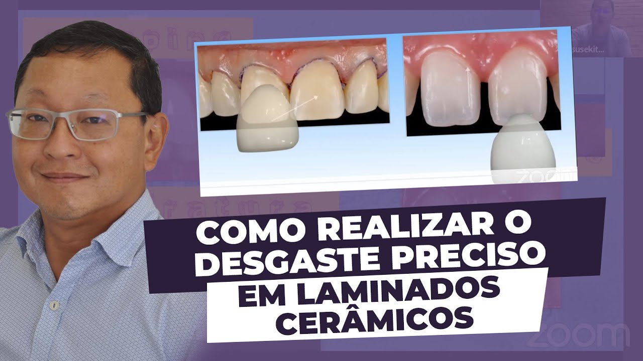 Como realizar preparos para laminados cerâmicos