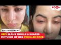 Urfi Javed shares pics of her face swollen from allergies; says &#39;Fillers nahi hai guys..&#39;