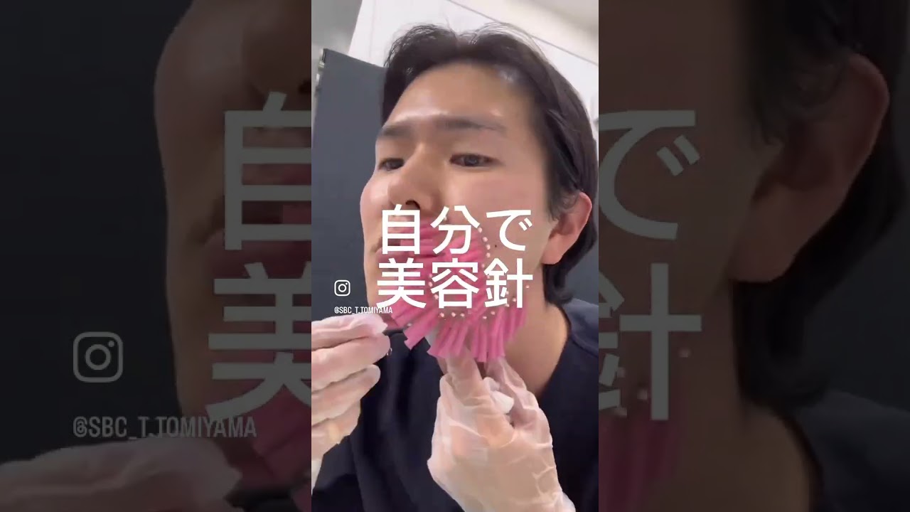 こんなに変わるの⁉️#糸リフト #ボトックス #hifu #美容針 #shorts